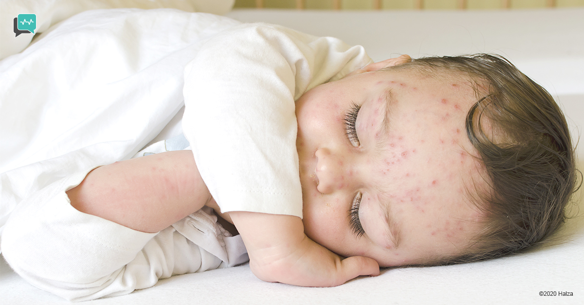 Baby with chicken pox
