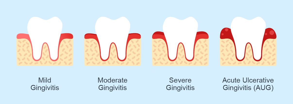 Gingivitis