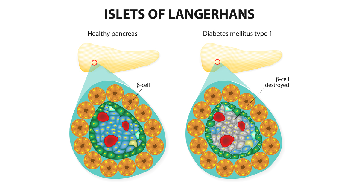 type 1 diabetes mellitus pancreas cause halza digital health 
